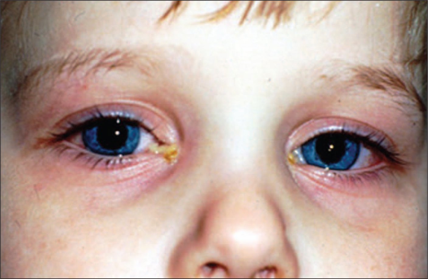 6 Things to Know About Conjunctivitis in Children (pink eye)
