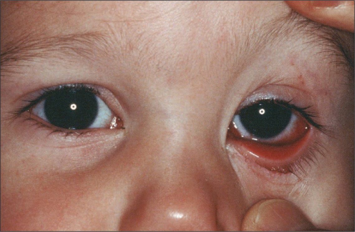 6 Things To Know About Conjunctivitis In Children Pink Eye Page 2