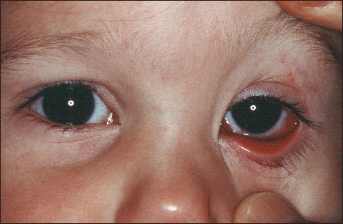 6 Things to Know About Conjunctivitis in Children (pink